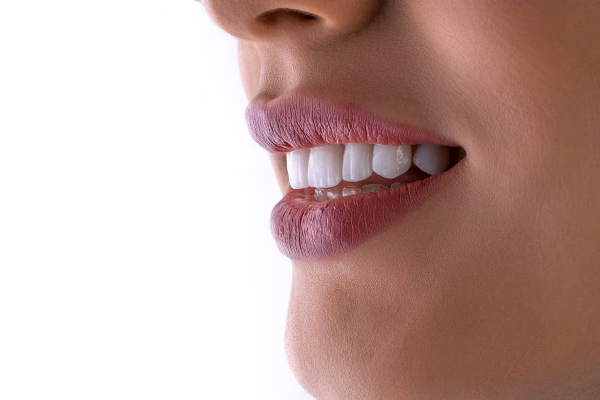 Blanqueamiento dental en Rincón de Milberg