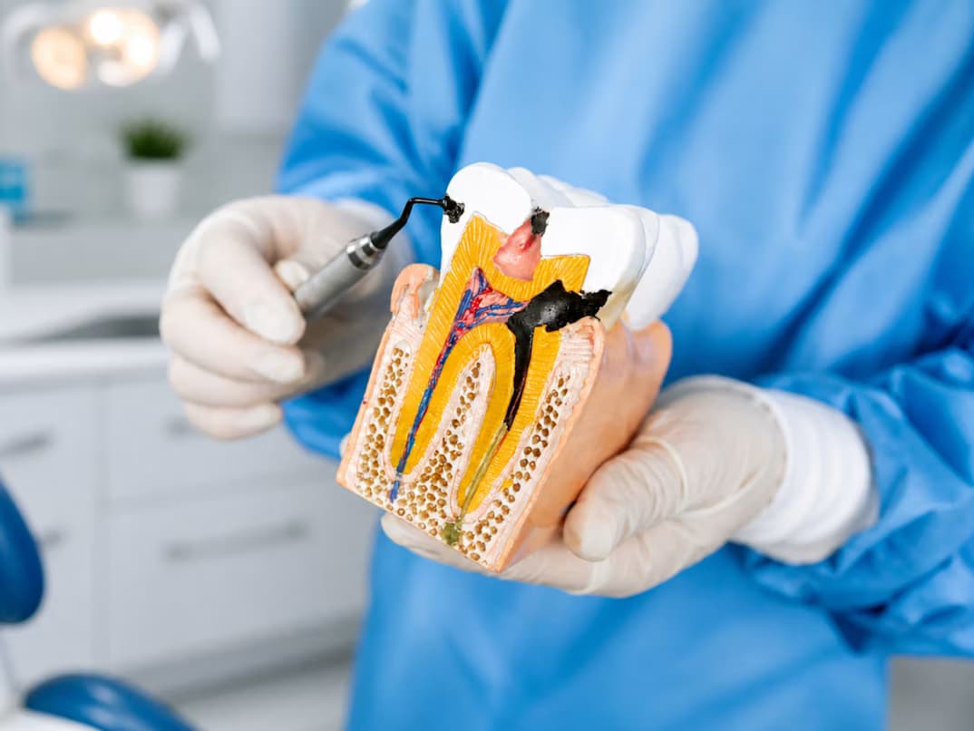 Caries en Rincón de Milberg
